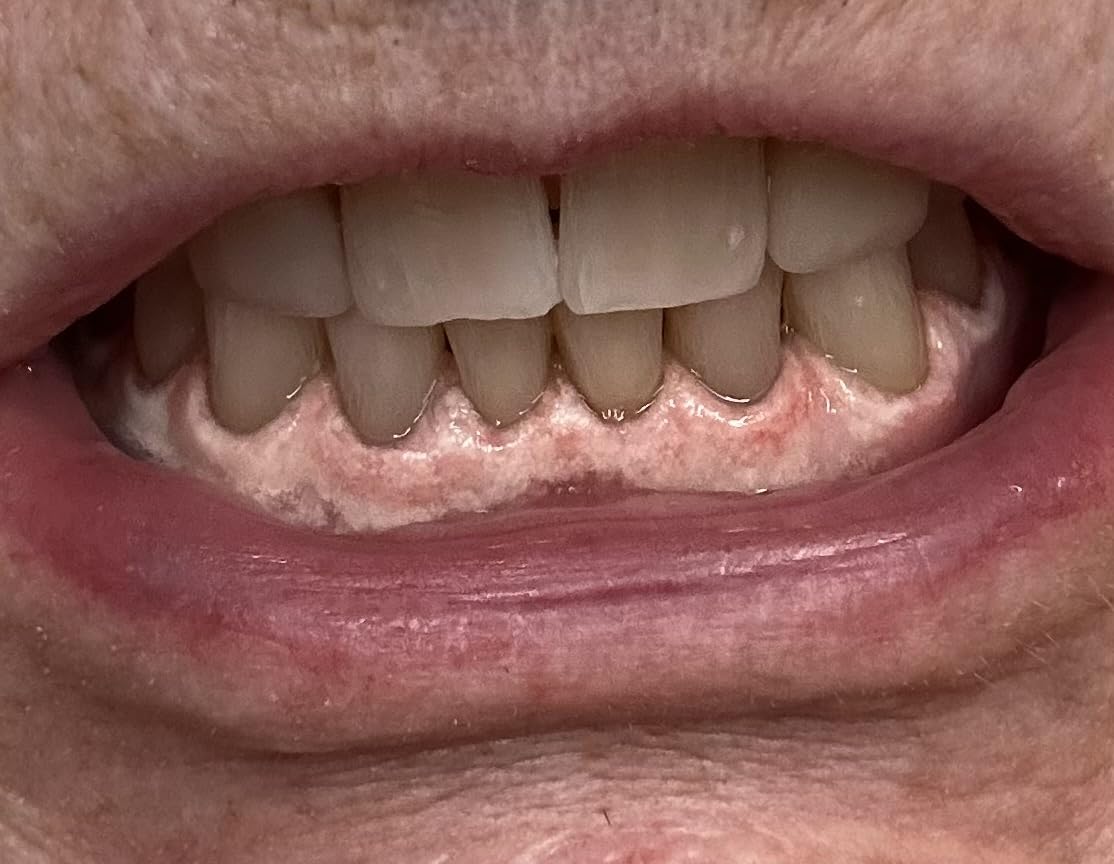 Auraglow Teeth Whitening Kit, LED Accelerator Light, 35% Carbamide Peroxide Teeth Whitening Gel, 20+ Whitening Treatments, Whitens up to 10 Shades in 7 Days customer photo 2