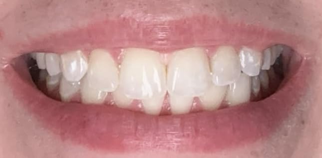 Crest 3D Whitestrips Express Whitening with Light, Teeth Whitening Strip Kit, 20 Strips (10 Count Pack) customer photo 1