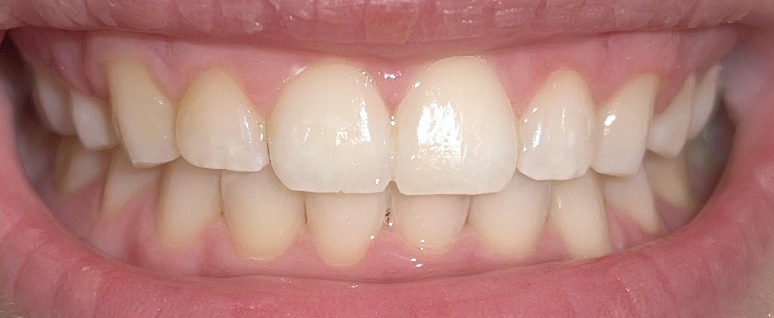 Crest 3D Whitestrips Express Whitening with Light, Teeth Whitening Strip Kit, 20 Strips (10 Count Pack) customer photo 2