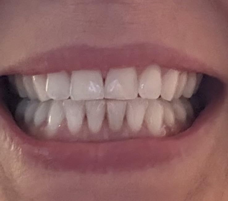 Novashine Professional Teeth Whitening Kit: Advanced Blue LED Light, Concentrated Peroxide Gel, Smartphone Adapter, Travel Bag customer photo 1