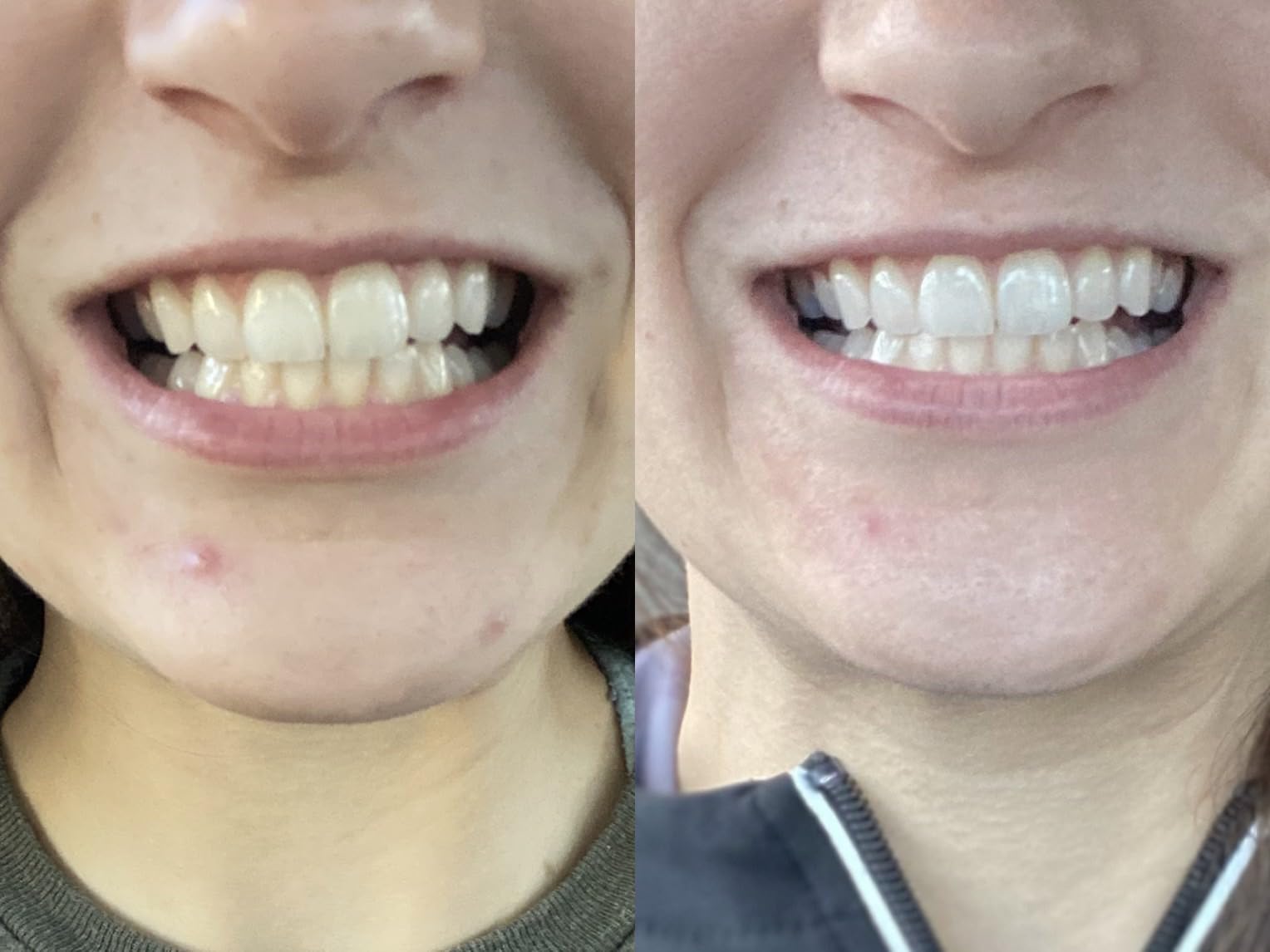 SmileDirectClub Teeth Whitening Kit with LED Light - 4 Pack Gel Pens - Professional Strength Hydrogen Peroxide customer photo 1