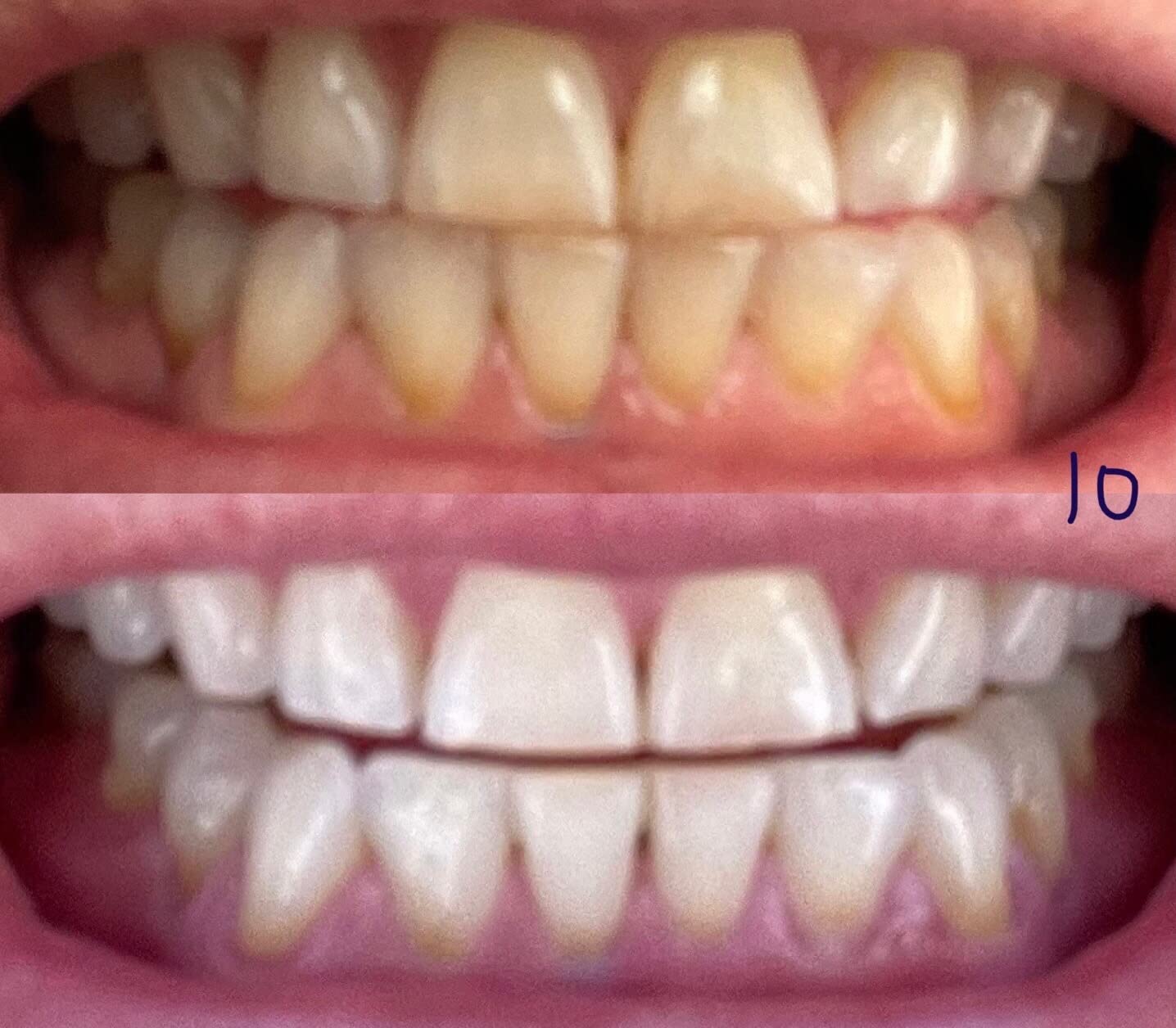 Auraglow Plug-in LED Teeth Whitening Kit - Wired Light Device - 35% Carbamide Peroxide Gel - 12 Treatments - Enamel-Safe at-Home Whitening for Coffee & Tea Stains customer photo 1