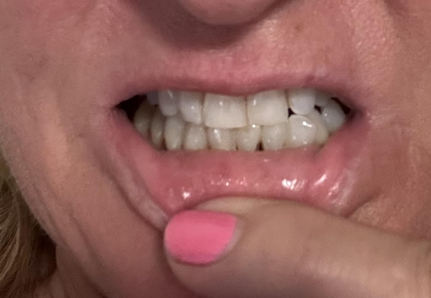 Auraglow Plug-in LED Teeth Whitening Kit - Wired Light Device - 35% Carbamide Peroxide Gel - 12 Treatments - Enamel-Safe at-Home Whitening for Coffee & Tea Stains customer photo 2