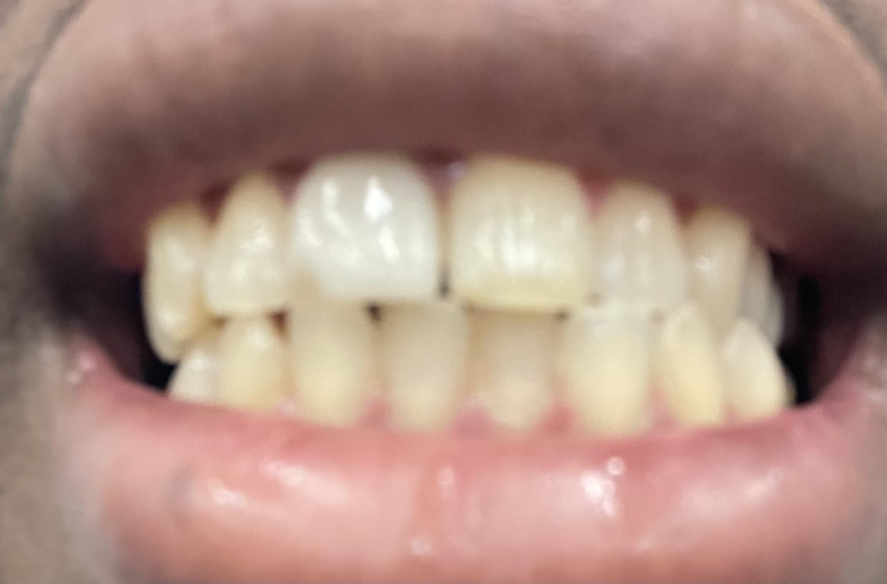 Opalescence Go 15% Mint - Prefilled Teeth Whitening Trays - 5194 | Hydrogen Peroxide Formula (10 Treatments) - Fast Results - Dentist Developed - Low Sensitivity - Gentle on Enamel - Mint customer photo 1